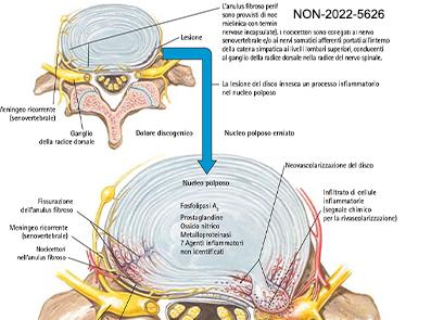 Ruolo dell'infiammazione nel dolore lombare