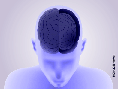 atrofia della materia grigia